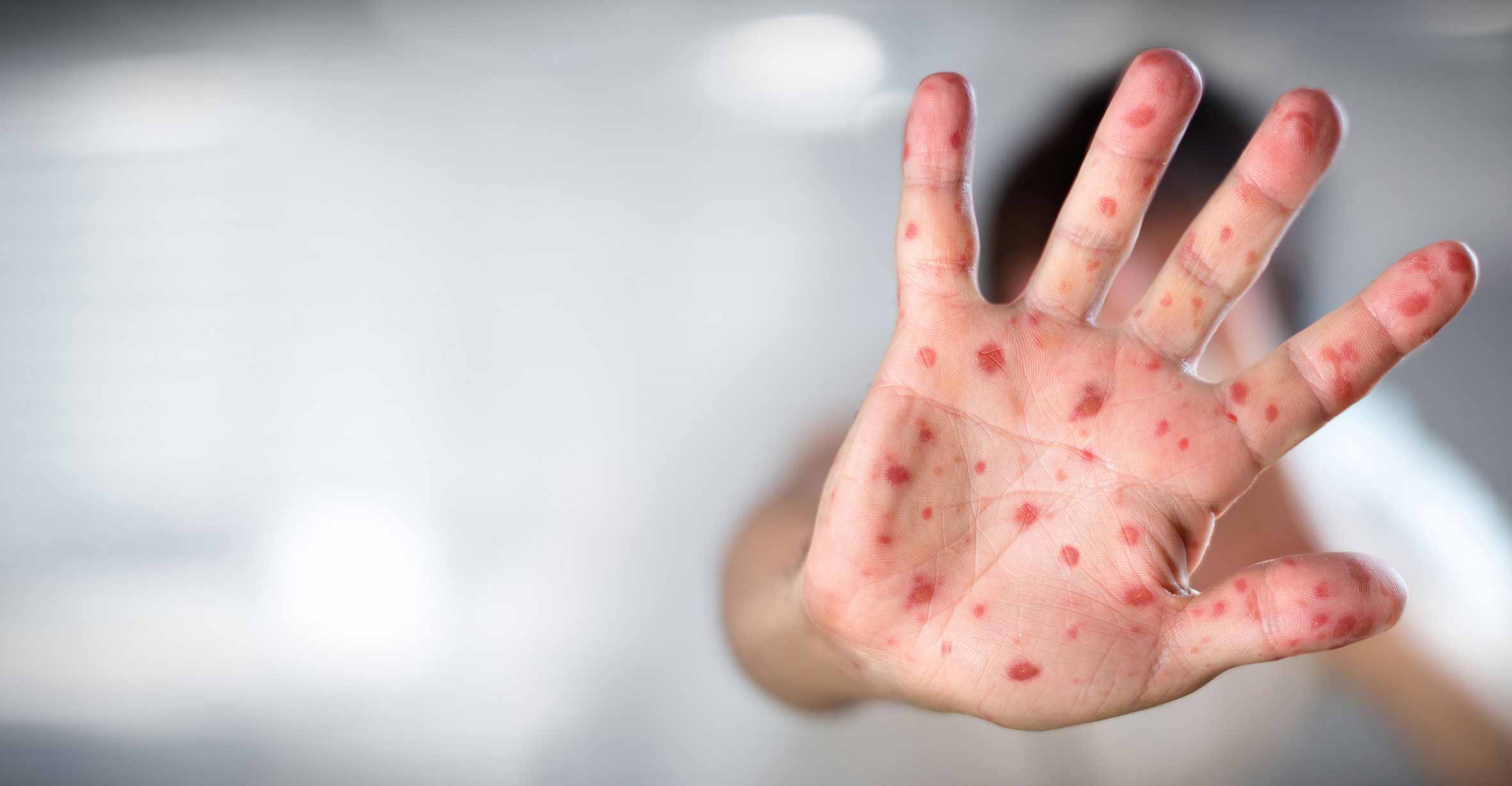 Measles, mumps, and rubella are highly contagious diseases that can lead to severe complications, including pneumonia, meningitis, and even long-term health problems. By receiving the MMR vaccine, you can safeguard yourself and the people around you, especially vulnerable individuals who cannot be vaccinated.